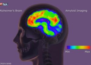 اختبار جديد للدم يمكنه الكشف عن الزهايمر خلال مراحله المبكرة