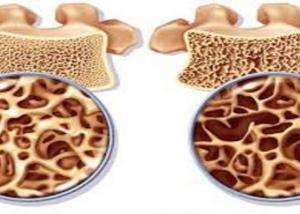 حقن الخلايا الجذعية لعلاج هشاشة العظام خلال 6 أشهر
