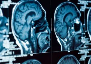 علماء يقومون بتحديد المنشأ الفيزيائي للاكتئاب في الدماغ
