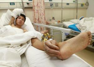 أطباء صينيون يزرعون يد مريض في قدمه